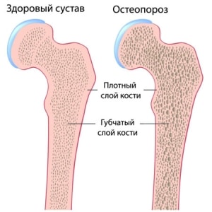 ювенильный остеопороз