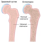 Ювенильный остеопороз. Особенности лечения и профилактики. Часть 3