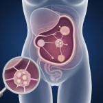 Фибромиомы матки: когда «молчаливая опухоль» становится проблемой